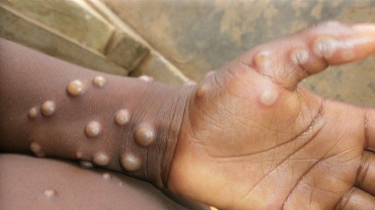monkeypox