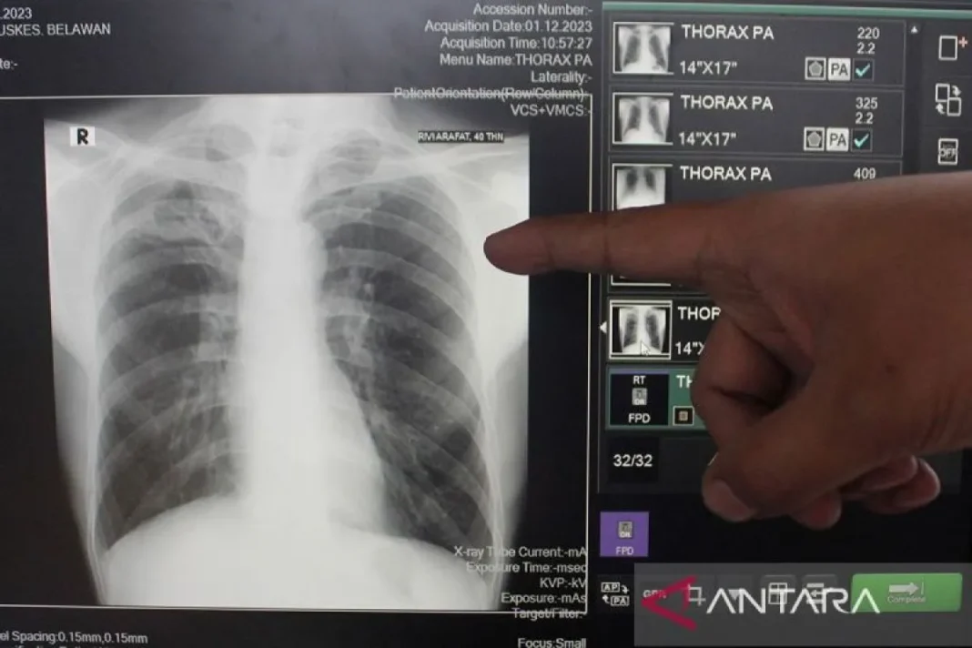 Kemenkes deteksi 889 ribu orang yang terkena TB per Maret 2025